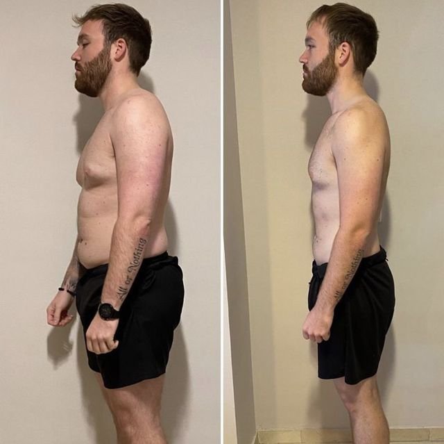 Antes e depois de paciente que perdeu 20 kg